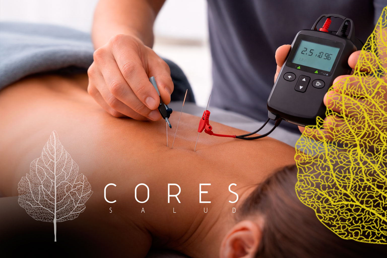 Centro Cores Salud - Neuromodulación Percutánea Cuenca